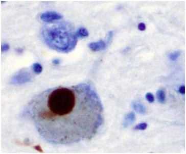 Science：在<font color='red'>帕金森病</font>早期進行抗氧化劑治療有望阻止神經退化，改善神經元功能