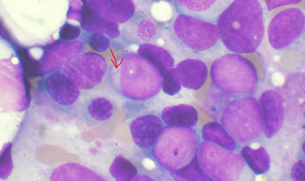 Cell：突破！科學家利用CRISPR/Cas9改造造血干細胞 促進CAR-T細胞療法有效治療急性髓性白血病