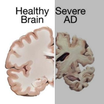 健康大腦和AD患者大腦比較