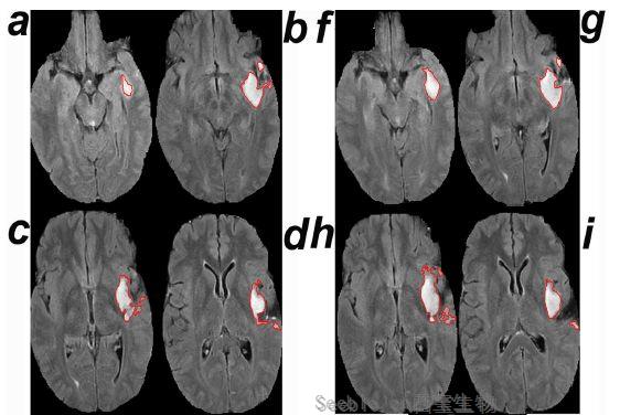 PLOS Med：計算機輔助<font color='red'>診斷程序</font>讓醫生更早發現腦腫瘤的生長