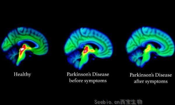 Lancet Neurol：研究揭示了帕金森的大腦根源