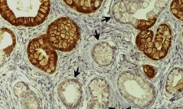 CMGH：揭秘慢性胰腺炎誘發胰腺癌發生的分子機制