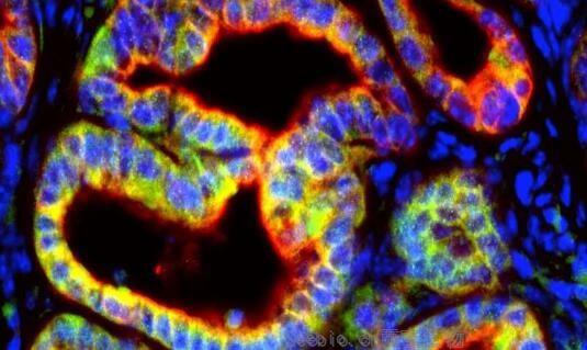 Cancer Res：胰腺癌細胞或會分泌特殊信號來阻斷機體對腫瘤的免疫攻擊