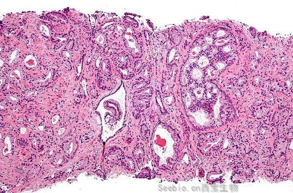 NEJM重大進展：乳腺癌藥物治療<font color='red'>前列腺</font>癌比標準療法更有效！