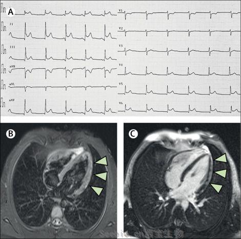 Lancet：一名感染SARS-CoV-2的16歲男孩患上心肌炎