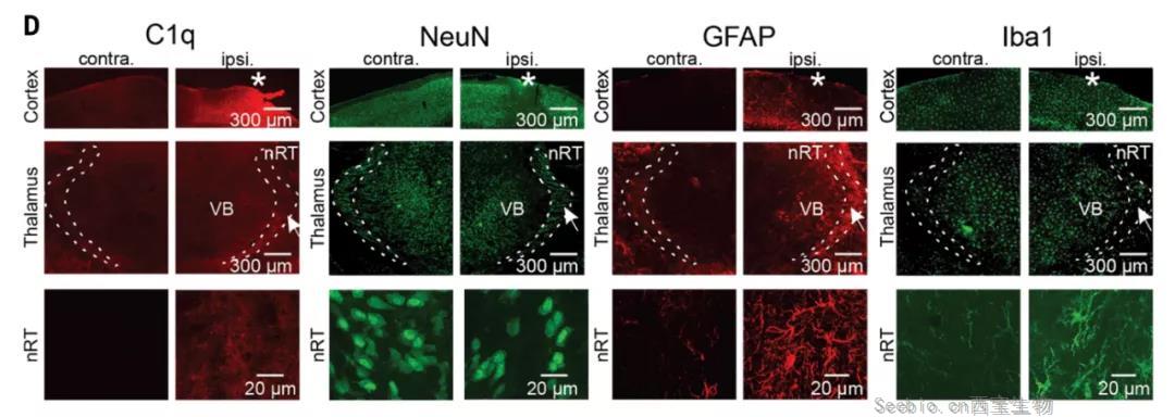 顱腦創傷后的繼發性腦損傷是怎么發生的？Science：補體介導炎癥及神經損傷！