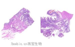 研究揭示了同時(shí)發(fā)生APC和MLH1種系突變的結(jié)直腸腫瘤的體細(xì)胞突變譜